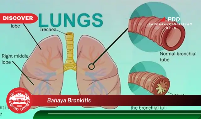 bahaya bronkitis