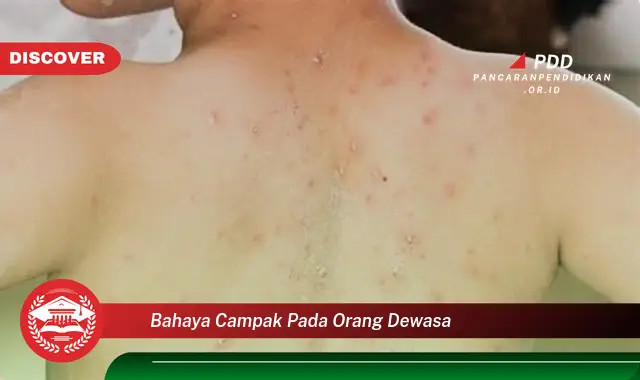 bahaya campak pada orang dewasa