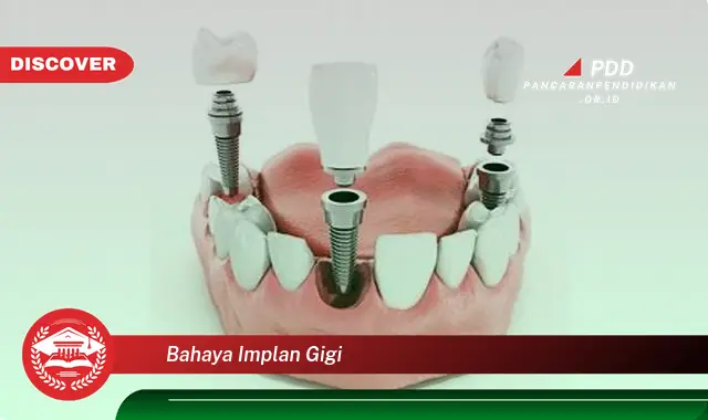 bahaya implan gigi