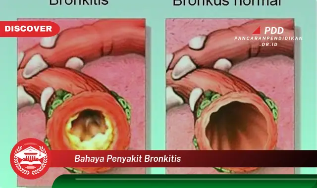 bahaya penyakit bronkitis