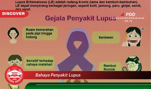 bahaya penyakit lupus